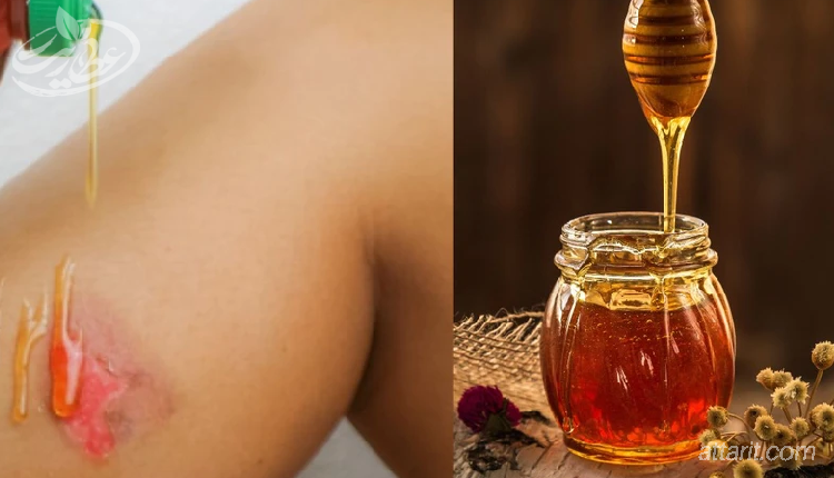 درمان سریع سوختگی با عسل!